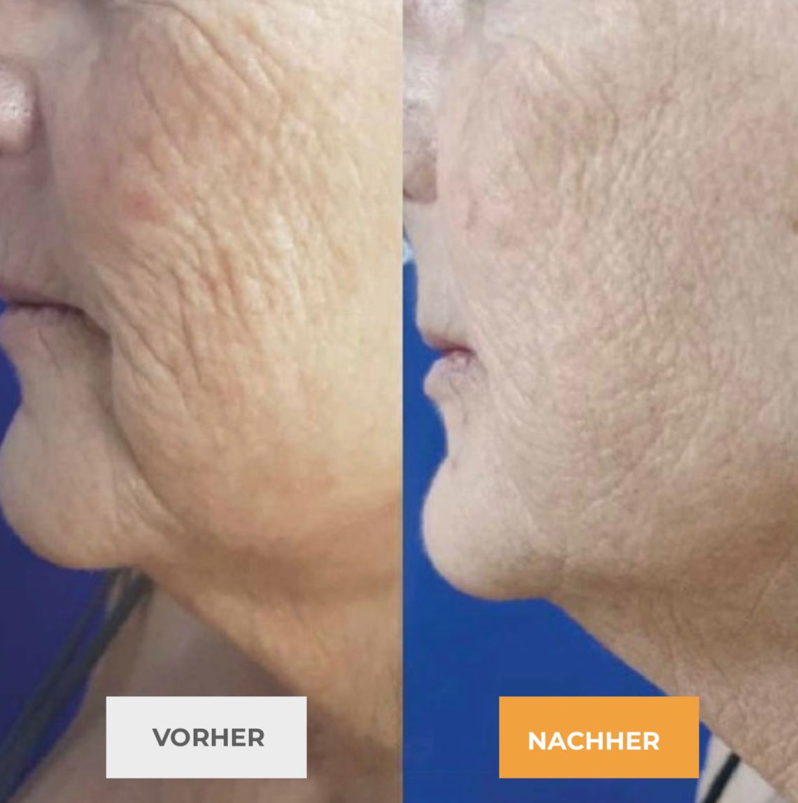 Exosomen Gesicht Hals vorher nachher – Faltenreduktion Michelfeld