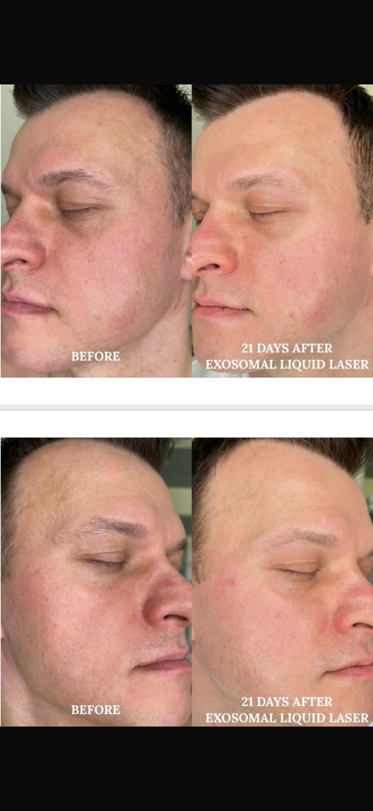 Microneedling mit Exosomen – Hautverjüngung in Michelfeld