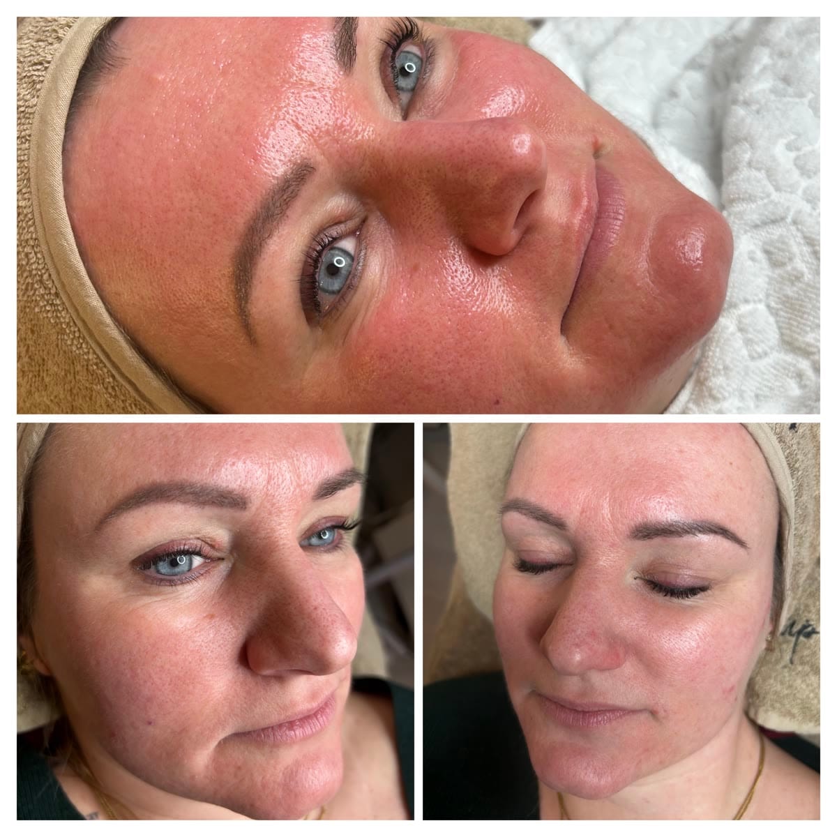 TCA Peeling – Professionelle Hauterneuerung in Michelfeld bei Schwäbisch Hall