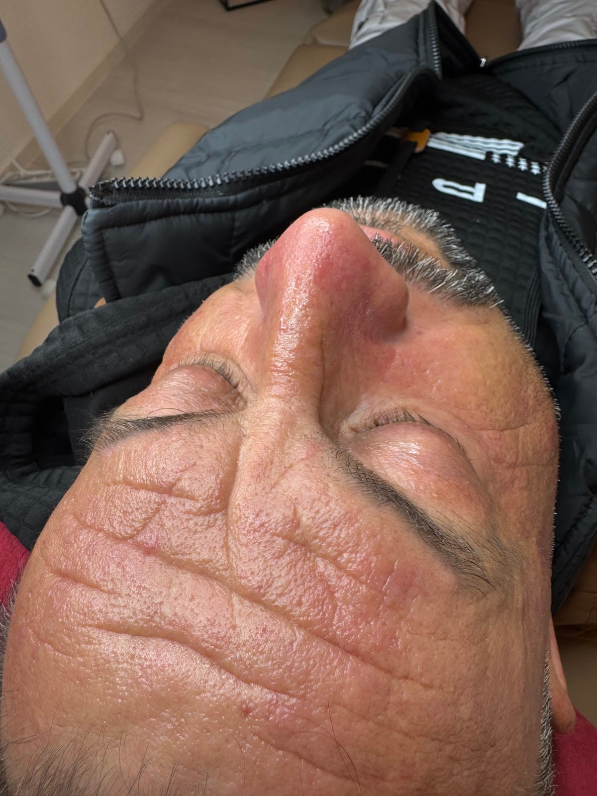 Hautpflege nach RF Microneedling Behandlung