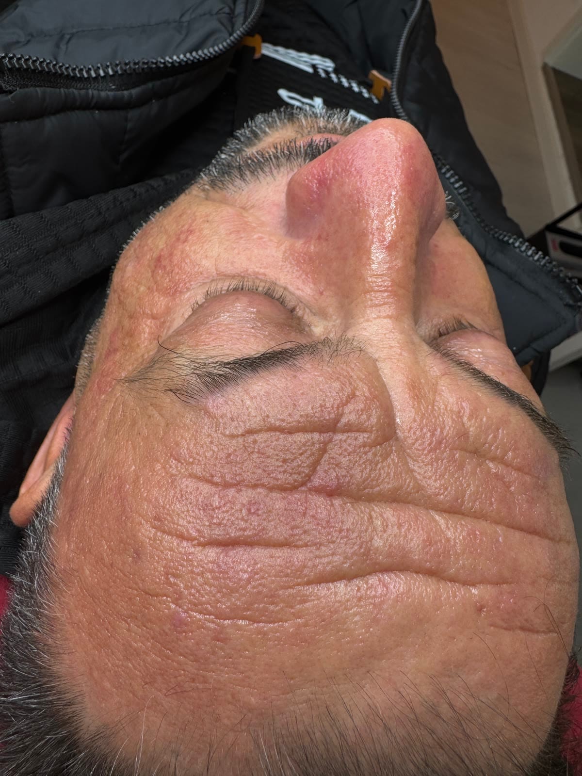 Exosomen-Therapie für Haarregeneration – dichteres Haar in Michelfeld