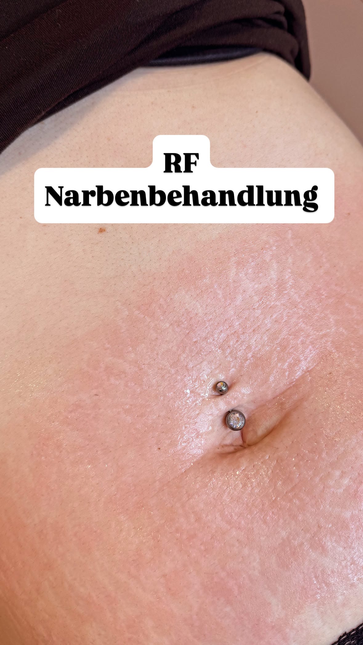 RF Microneedling Narbenbehandlung – Vorher-Nachher